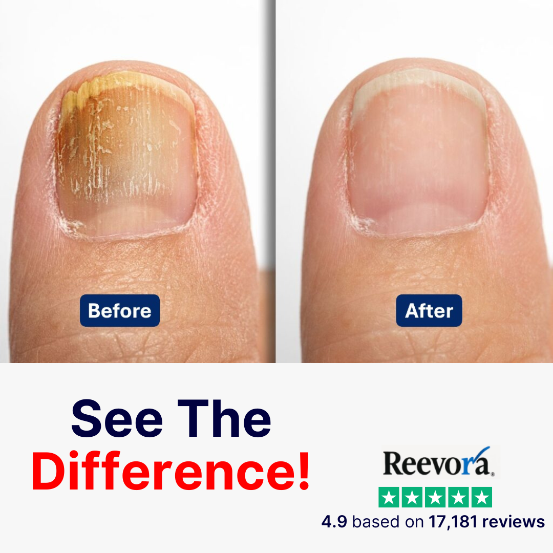 Fungal Nail Repair Patches