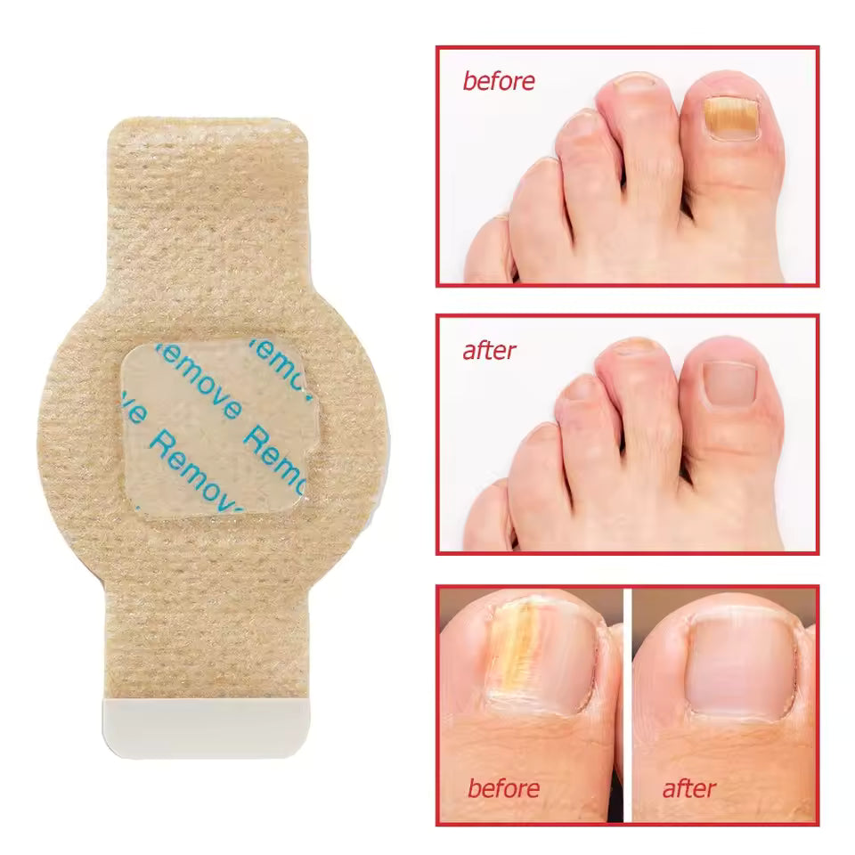Fungal Nail Repair Patches